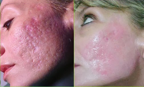 does sperm help acne Ass in things weird